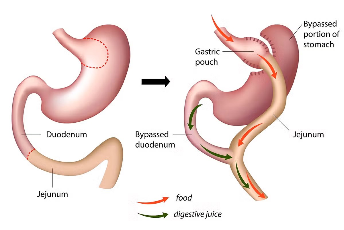 Roux-en-Y Gastric Bypass Procedure